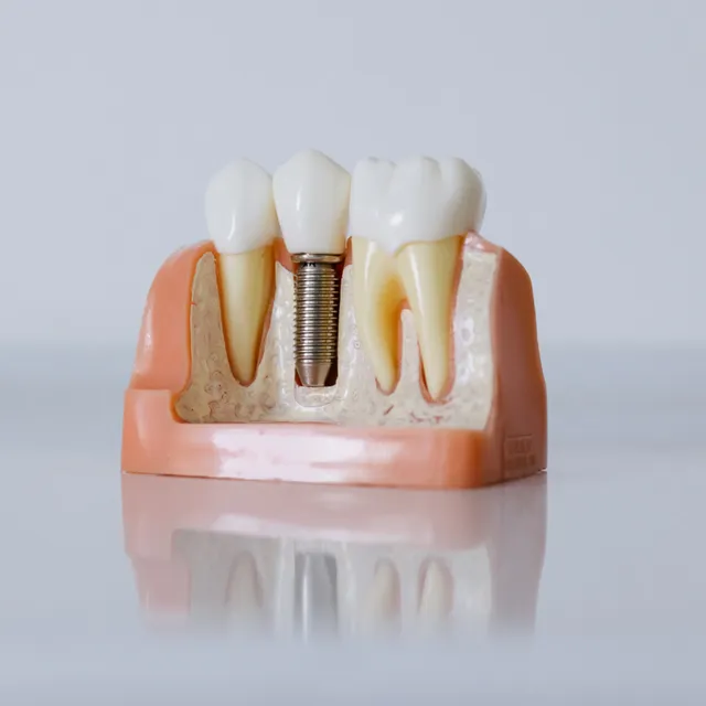 A dental model showing an implant post beneath a crown